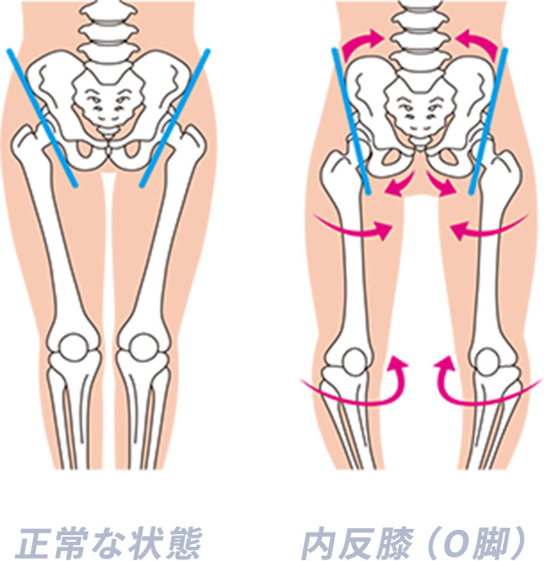 骨盤の正常な状態と内反膝(O脚)